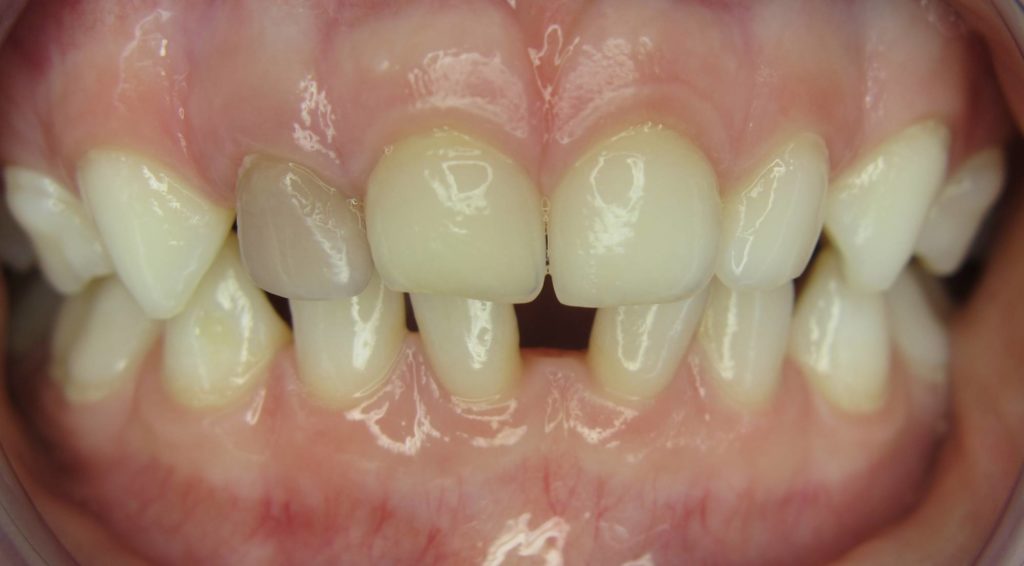 Grau kind zahn verfärbt sich Zahnverfärbung