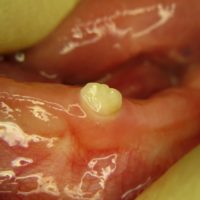 Erster Zahnarztbesuch mit dem ersten Zahn erster Zahn