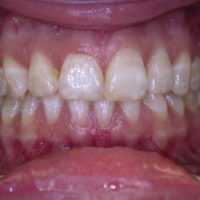 Zahnpflegetipps Fluorose
