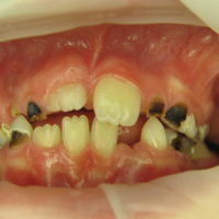 extrem kariöse Zähne 2